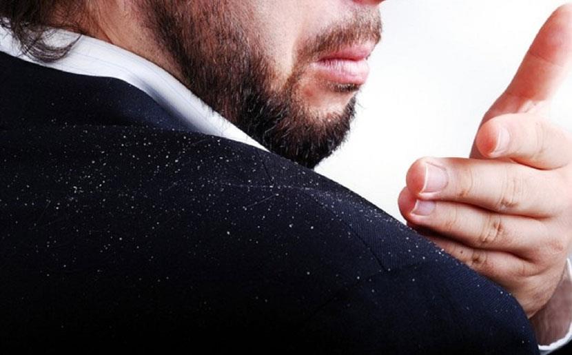 What are the symptoms of dandruff? 